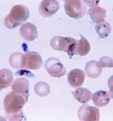 Malaria